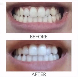 ap 24 whitening toothpaste before after